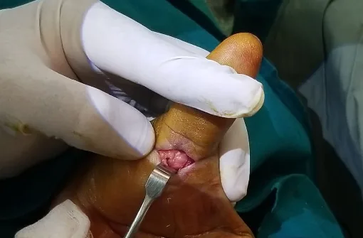 Surgical-removal