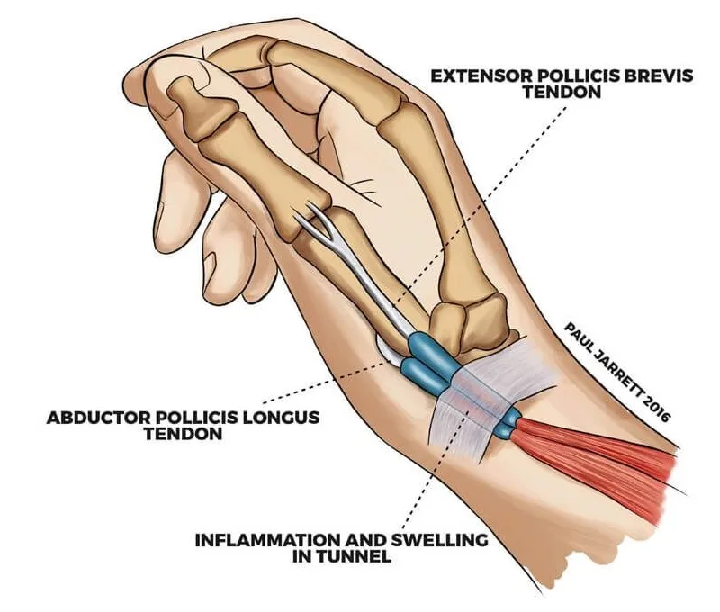 bnj-DeQuervain’s-Tenosynovitis