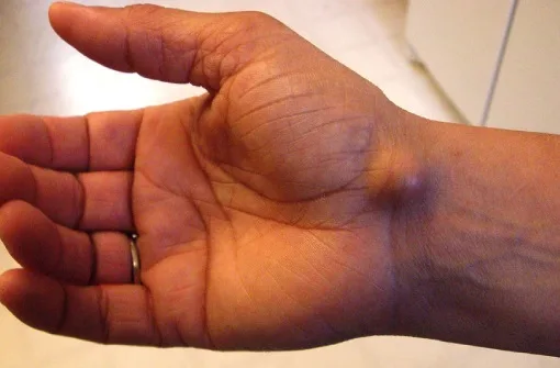 bnj-cyst