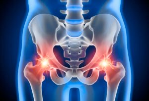 Hip Fractures in the elderly